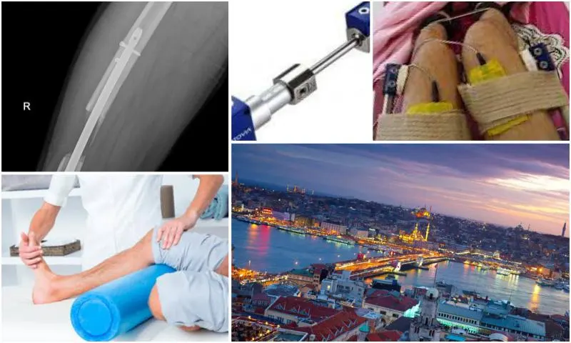 Uzuv Uzatma Cerrahisi 2020- Limb Lengthening Surgery 2020