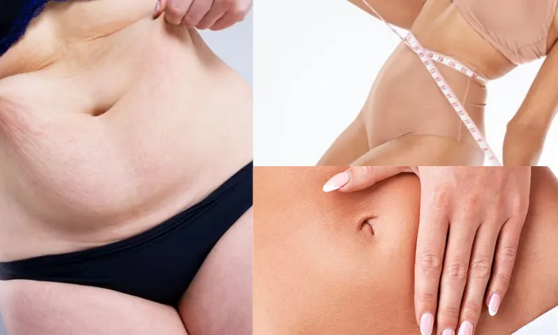 Vaser Liposuction Nedir?