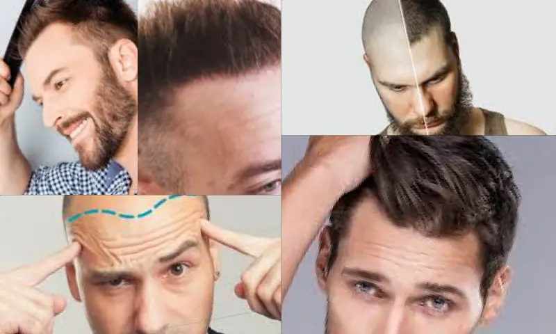 Fue Hair Transplant Fue Saç Ekimi