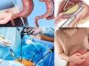 Gastrik Sleeve ile Tüp Mide Ameliyatı Arasındaki Farklar Nelerdir?