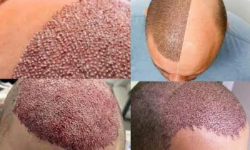 İstanbul’da Saç Ekimi - Hair Transplant in İstanbul Nerede Yaptırılır?