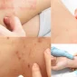 Alerjik Hastalıkların Tanımı ve Türleri